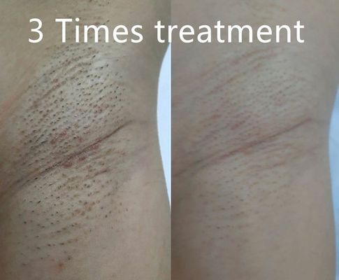 다양한 펄스 폭을 지원하여 맞춤형 영구 제모를 위한 다기능 다이오드 레이저 제모 장치