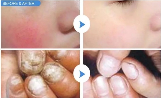 발톱 치료 / 뜨거운 레이저 피부 젊어지기 위해 15W 30W 레이저 혈관 제거 기계