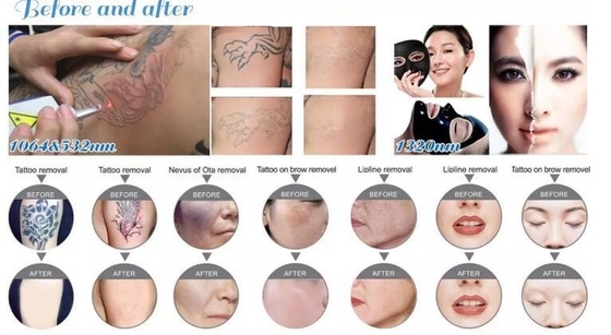 532nm 1064nm 1320nm Q 스위치 ND YAG 레이저 머신 피부 백화 / 어두운 원