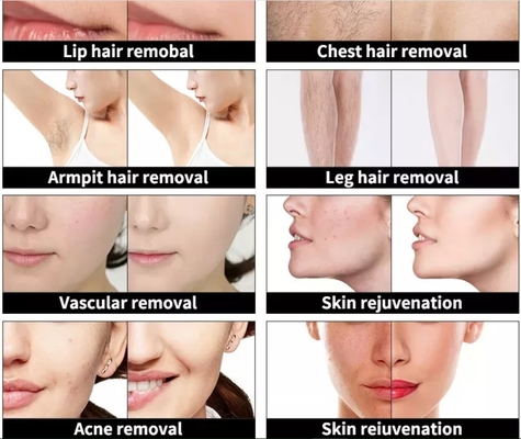 4 in 1 다기능 미용 기계 세 개의 파장 레이저 헤어 문신 제거 기계